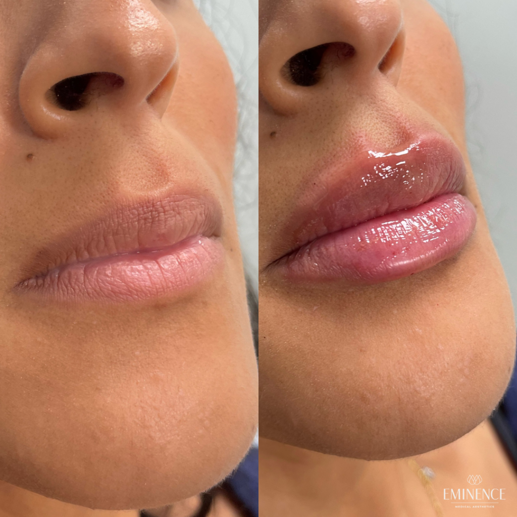 Lip Filler Results Princeton Montgomery NJ Eminence