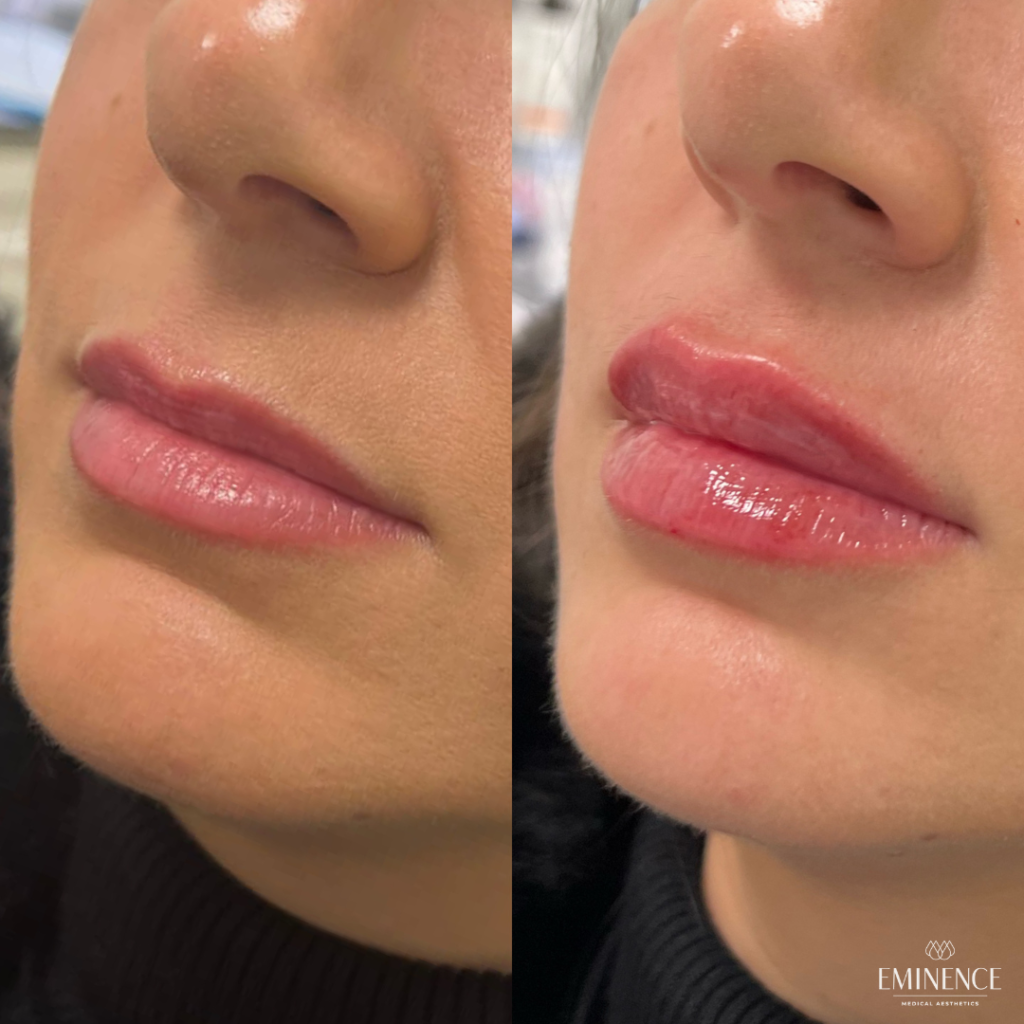 Lip Filler Results Princeton, Montgomery NJ Eminence