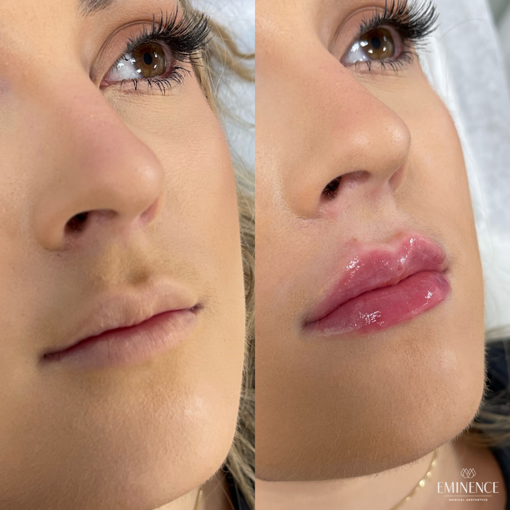 Lip Filler Results Princeton Montgomery Nj Eminence