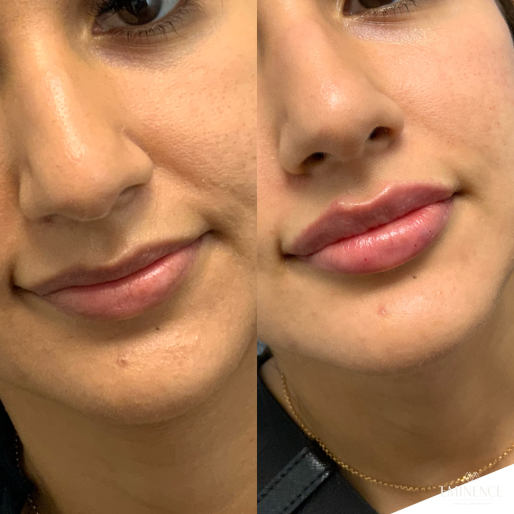 Lip Filler Results Princeton, Montgomery NJ Eminence