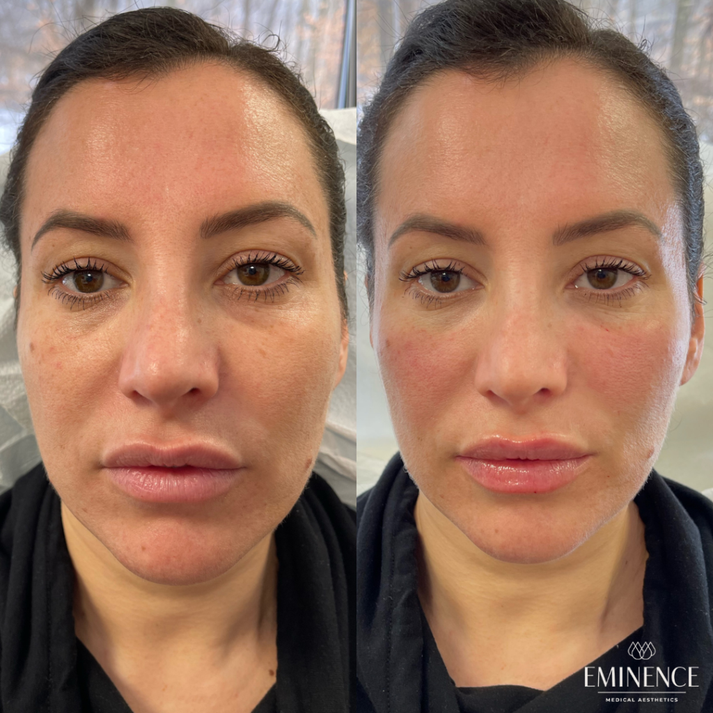 Dermal Filler Results | Princeton, Montgomery NJ Eminence