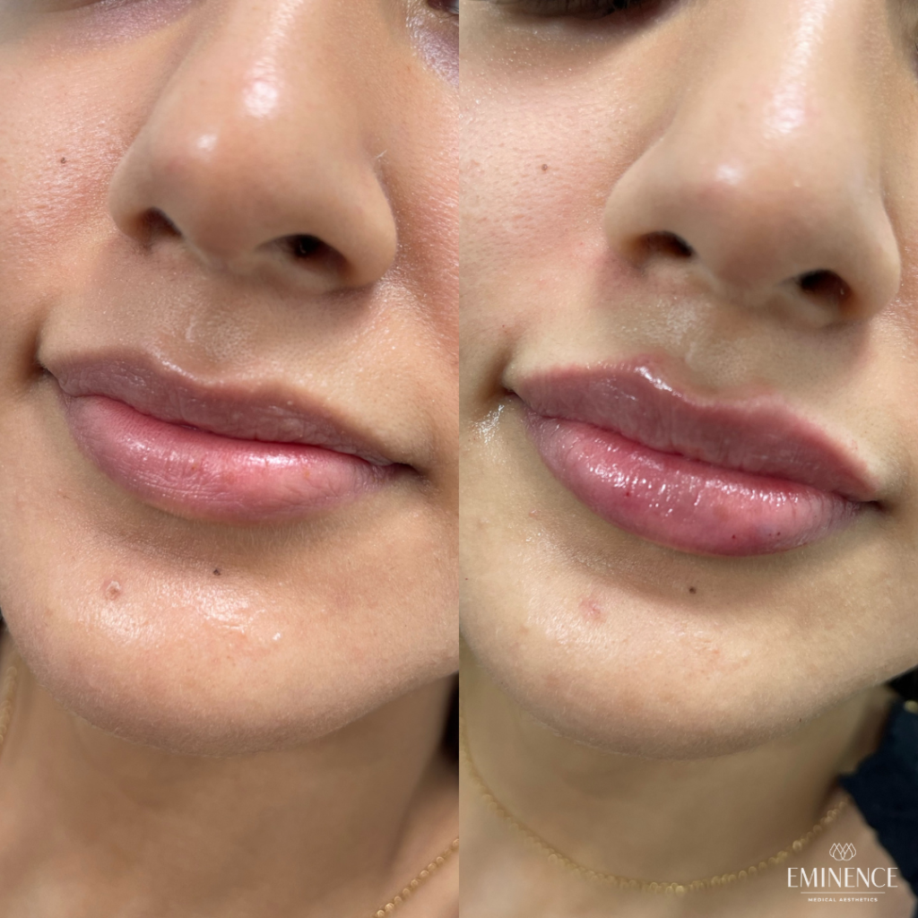 Lip Filler Results Princeton, Montgomery NJ Eminence
