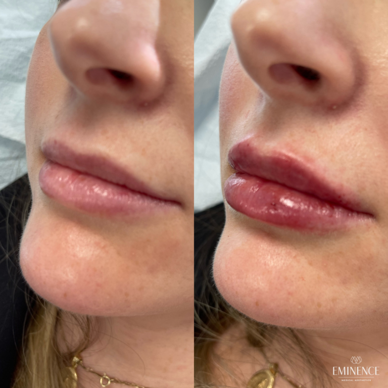 Lip Filler Results Princeton, Montgomery NJ Eminence