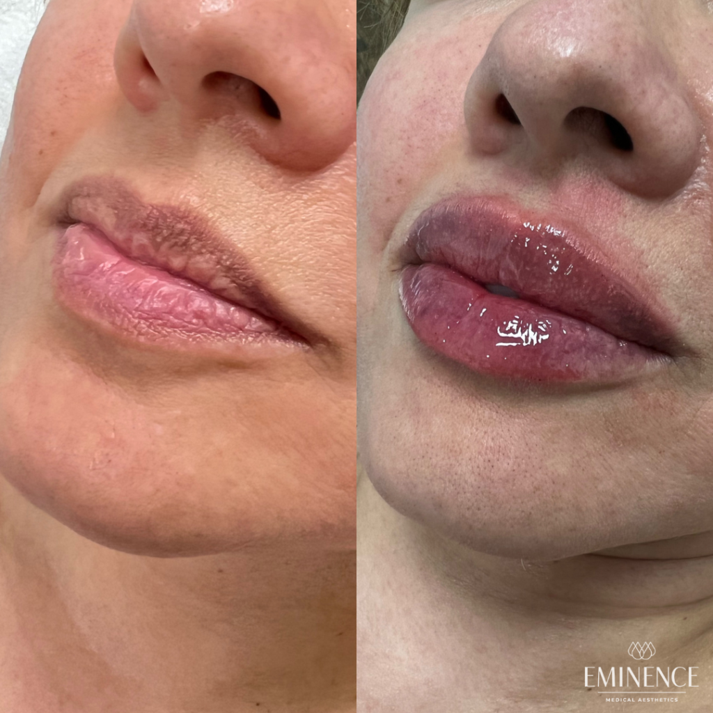 Lip Filler Results Princeton, Montgomery NJ Eminence