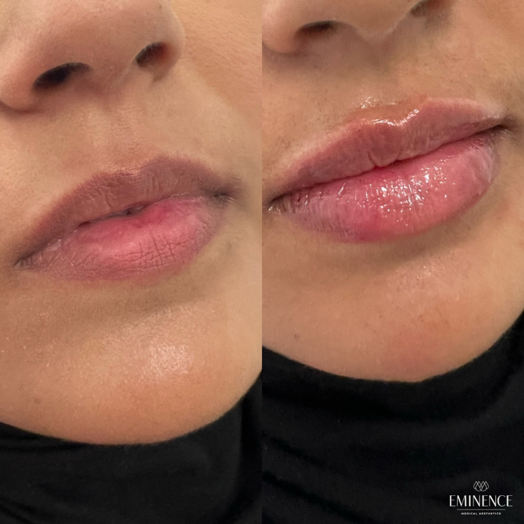 Lip Filler Results Princeton, Montgomery NJ Eminence