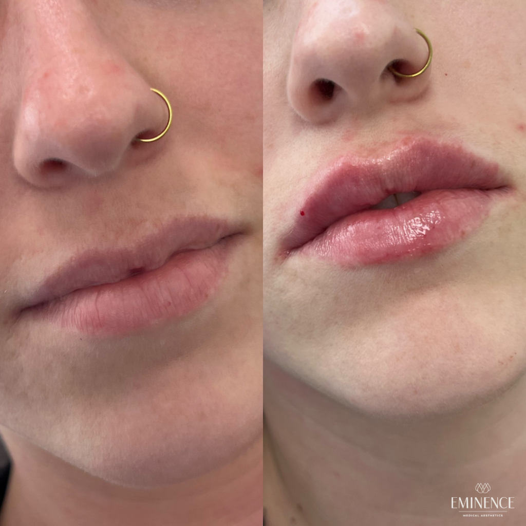 Lip Filler Results Princeton Montgomery Nj Eminence