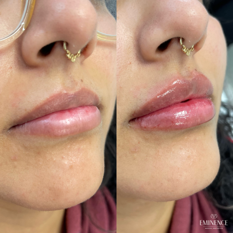 Lip Filler Results Princeton, Montgomery NJ Eminence