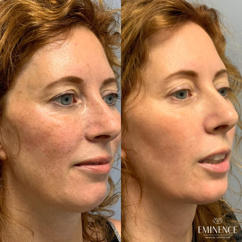Laser Genesis Results Princeton, Montgomery NJ Eminence