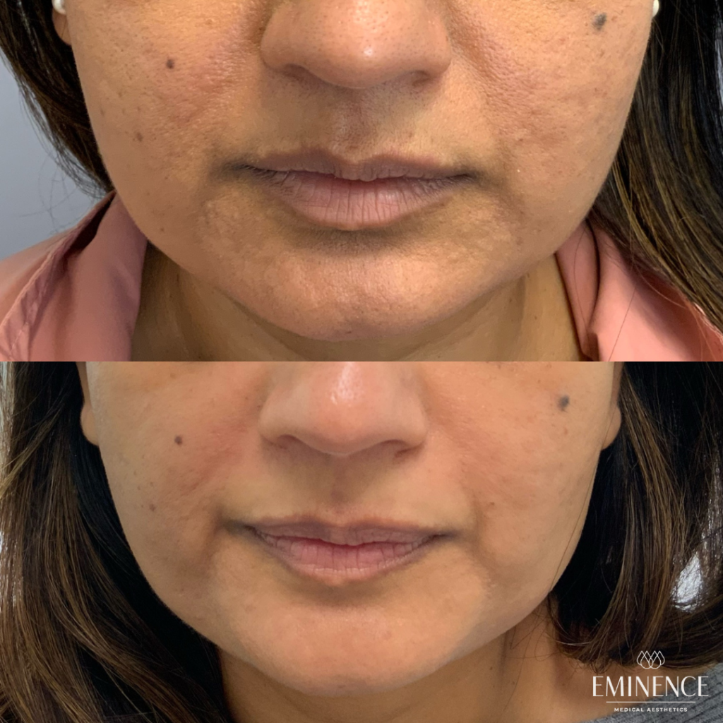 Radiofrequency Results Princeton, Montgomery NJ Eminence