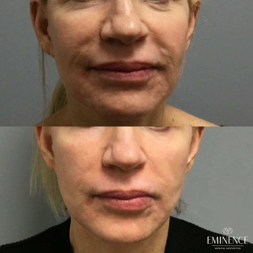 Radiofrequency Results Princeton, Montgomery NJ Eminence