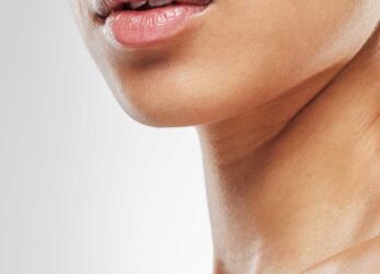 radiesse treatments